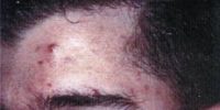 acné-docteur-savary-traitement-4